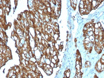 TROP2 / TACSTD2 Antibody - IHC testing of FFPE human colon carcinoma with TROP2 antibody (clone TACSTD2/2151). Required HIER: boil tissue sections in pH6, 10mM citrate buffer, for 10-20 min followed by cooling at RT for 20 min.