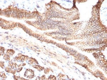 TROP2 / TACSTD2 Antibody - IHC testing of FFPE human pancreatic carcinoma with TROP2 antibody (clone TACSTD2/2151). Required HIER: boil tissue sections in pH6, 10mM citrate buffer, for 10-20 min followed by cooling at RT for 20 min.