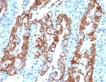 TROP2 / TACSTD2 Antibody - IHC testing of FFPE human colon carcinoma with TROP2 antibody (clone TCSR2-1). Required HIER: boil tissue sections in pH6, 10mM citrate buffer, for 10-20 min followed by cooling at RT for 20 min.