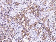 TROP2 / TACSTD2 Antibody - Immunochemical staining of human TROP2 in human breast carcinoma with rabbit polyclonal antibody at 1:1000 dilution, formalin-fixed paraffin embedded sections.