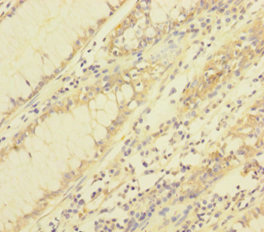 TRP32 / TXNL1 Antibody - Immunohistochemistry of paraffin-embedded human colon cancer using TXNL1 Antibody at dilution of 1:100