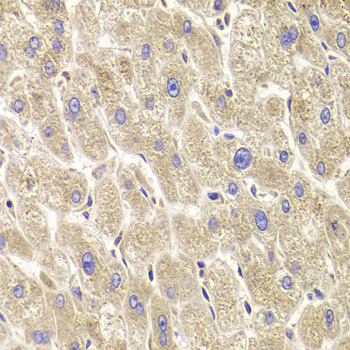 TRP32 / TXNL1 Antibody - Immunohistochemistry of paraffin-embedded human liver injury tissue.