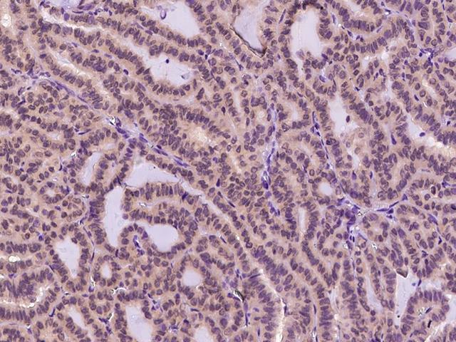 TRP32 / TXNL1 Antibody - Immunochemical staining TXNL1 in human thyroid carcinoma with rabbit polyclonal antibody at 1:1000 dilution, formalin-fixed paraffin embedded sections.