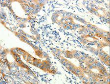 TRPA1 Antibody - Immunohistochemistry of paraffin-embedded Human lung cancer using TRPA1 Polyclonal Antibody at dilution of 1:60.