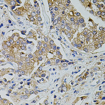 TRPA1 Antibody - Immunohistochemistry of paraffin-embedded human prostate cancer tissue.