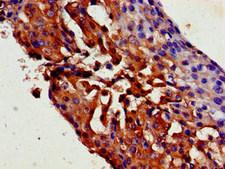 TRPC1 Antibody - Immunohistochemistry image of paraffin-embedded human breast cancer at a dilution of 1:100