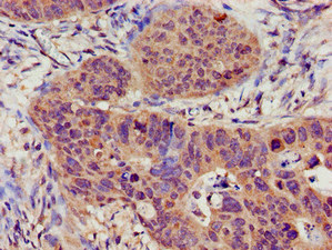TRPC1 Antibody - Immunohistochemistry image of paraffin-embedded human colon cancer at a dilution of 1:100