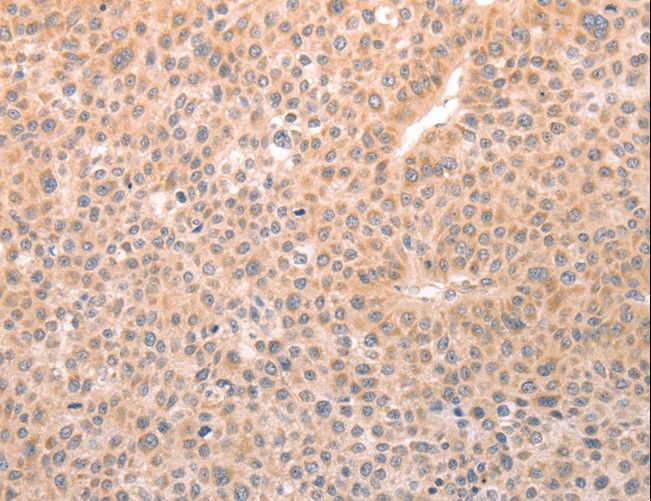 TRPC3 Antibody - Immunohistochemistry of paraffin-embedded Human thyroid cancer using TRPC3 Polyclonal Antibody at dilution of 1:50.