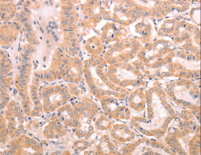 TRPC3 Antibody - Immunohistochemistry of paraffin-embedded Human thyroid cancer using TRPC3 Polyclonal Antibody at dilution of 1:50.