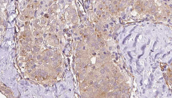 TRPC4AP / TRUSS Antibody - 1:100 staining human thyroid carcinoma tissue by IHC-P. The sample was formaldehyde fixed and a heat mediated antigen retrieval step in citrate buffer was performed. The sample was then blocked and incubated with the antibody for 1.5 hours at 22°C. An HRP conjugated goat anti-rabbit antibody was used as the secondary.