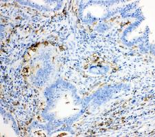 TRPC6 Antibody - TRPC6 antibody. IHC(P): Human Intestinal Cancer Tissue.