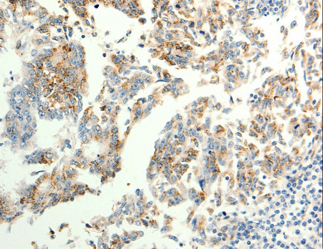 TRPC6 Antibody - Immunohistochemistry of paraffin-embedded Human gastric cancer using TRPC6 Polyclonal Antibody at dilution of 1:40.