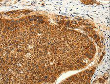 TRPC6 Antibody - Immunohistochemistry of paraffin-embedded Human lung cancer using TRPC6 Polyclonal Antibody at dilution of 1:50.