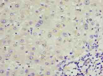 TRPM2 Antibody - Immunohistochemistry of paraffin-embedded human liver cancer using antibody at dilution of 1:100.