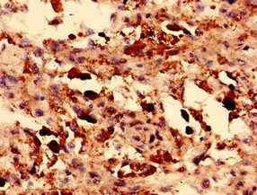 TRPM2 Antibody - Immunohistochemistry analysis of human melanoma using TRPM2 Antibody at dilution of 1:100