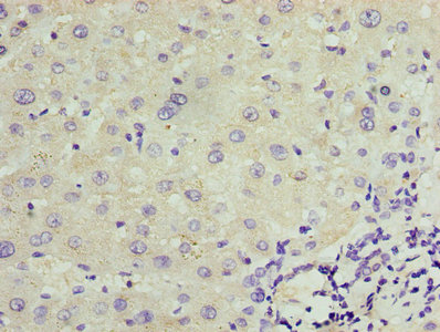 TRPM2 Antibody - Immunohistochemistry of paraffin-embedded human liver cancer using TRPM2 Antibody at dilution of 1:100