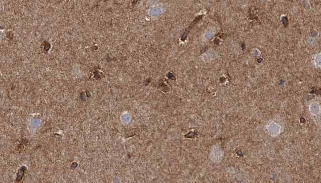 TRPM2 Antibody - 1:100 staining human brain carcinoma tissue by IHC-P. The sample was formaldehyde fixed and a heat mediated antigen retrieval step in citrate buffer was performed. The sample was then blocked and incubated with the antibody for 1.5 hours at 22°C. An HRP conjugated goat anti-rabbit antibody was used as the secondary.