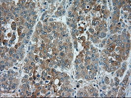 TRPM4 Antibody - Immunohistochemical staining of paraffin-embedded Carcinoma of liver tissue using anti-TRPM4 mouse monoclonal antibody. (Dilution 1:50).