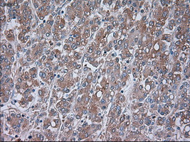 TRPM4 Antibody - IHC of paraffin-embedded Carcinoma of liver tissue using anti-TRPM4 mouse monoclonal antibody. (Dilution 1:50).