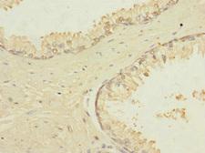 TRPM4 Antibody - Immunohistochemistry of paraffin-embedded human prostate cancer at dilution 1:100