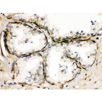 TRPM5 Antibody - TRPM5 was detected in paraffin-embedded sections of human prostatic cancer tissues using rabbit anti- TRPM5 Antigen Affinity purified polyclonal antibody at 1 ug/mL. The immunohistochemical section was developed using SABC method.