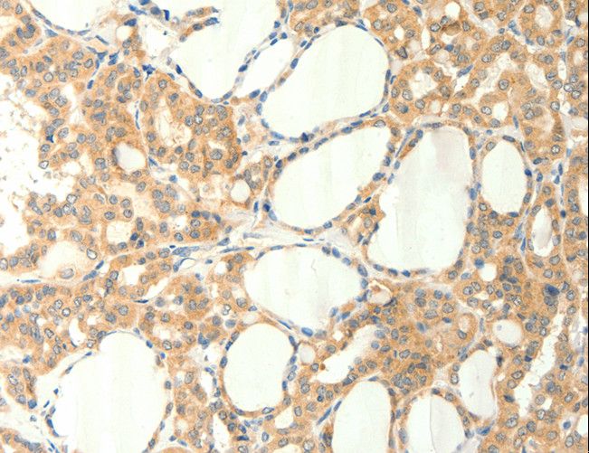 TRPM5 Antibody - Immunohistochemistry of paraffin-embedded Human thyroid cancer using TRPM5 Polyclonal Antibody at dilution of 1:60.