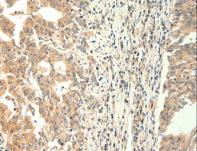 TRPM5 Antibody - Immunohistochemistry of paraffin-embedded Human gastric cancer using TRPM5 Polyclonal Antibody at dilution of 1:60.