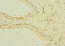 TRPM6 Antibody - Immunohistochemistry of paraffin-embedded human prostata cancer at dilution 1:100