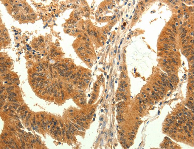 TRPM7 Antibody - Immunohistochemistry of paraffin-embedded Human liver cancer using TRPM7 Polyclonal Antibody at dilution of 1:30.