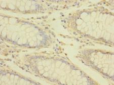 TRPM7 Antibody - Immunohistochemistry of paraffin-embedded human colon cancer at dilution 1:100