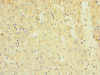 TRPM7 Antibody - Immunohistochemistry of paraffin-embedded human liver cancer at dilution 1:100