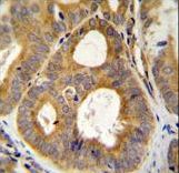 TRPM8 Antibody - TRPM8 Antibody immunohistochemistry of formalin-fixed and paraffin-embedded human prostate carcinoma followed by peroxidase-conjugated secondary antibody and DAB staining.
