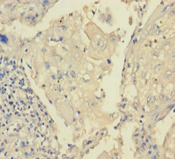 TRPM8 Antibody - Immunohistochemistry of paraffin-embedded human lung cancer using TRPM8 Antibody at dilution of 1:100