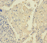 TRPM8 Antibody - Immunohistochemistry of paraffin-embedded human lung cancer using TRPM8 Antibody at dilution of 1:100