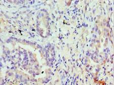 TRPM8 Antibody - Immunohistochemistry of paraffin-embedded human lung cancer at dilution 1:100