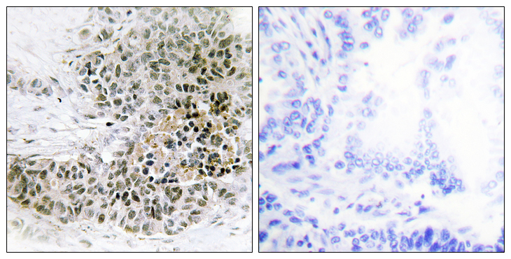 TRPS1 Antibody - Immunohistochemistry analysis of paraffin-embedded human lung carcinoma tissue, using TRPS1 Antibody. The picture on the right is blocked with the synthesized peptide.