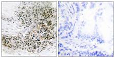 TRPS1 Antibody - Immunohistochemistry analysis of paraffin-embedded human lung carcinoma tissue, using TRPS1 Antibody. The picture on the right is blocked with the synthesized peptide.