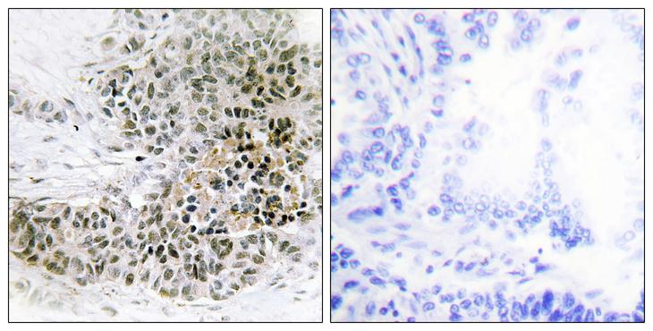 TRPS1 Antibody - Peptide - + Immunohistochemistry analysis of paraffin-embedded human lung carcinoma tissue, using TRPS1 antibody.
