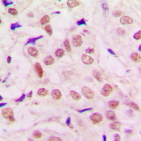 TRPS1 Antibody - Immunohistochemical analysis of TRPS1 staining in human lung cancer formalin fixed paraffin embedded tissue section. The section was pre-treated using heat mediated antigen retrieval with sodium citrate buffer (pH 6.0). The section was then incubated with the antibody at room temperature and detected using an HRP conjugated compact polymer system. DAB was used as the chromogen. The section was then counterstained with hematoxylin and mounted with DPX.