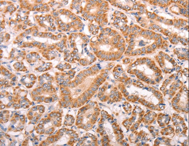 TRPV4 Antibody - Immunohistochemistry of paraffin-embedded Human liver cancer using TRPV4 Polyclonal Antibody at dilution of 1:40.