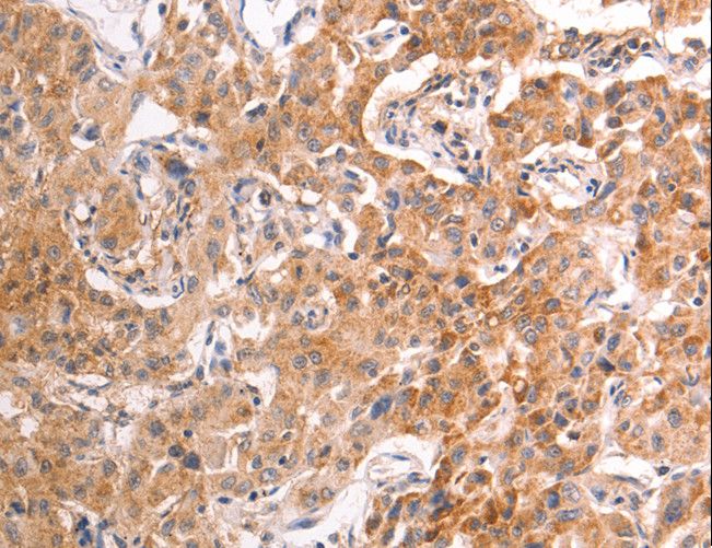 TRPV4 Antibody - Immunohistochemistry of paraffin-embedded Human liver cancer using TRPV4 Polyclonal Antibody at dilution of 1:40.