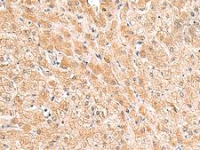 TRUB1 Antibody - Immunohistochemistry of paraffin-embedded Human liver cancer tissue  using TRUB1 Polyclonal Antibody at dilution of 1:85(×200)