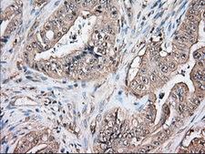 TS / Thromboxane Synthase Antibody - Immunohistochemical staining of paraffin-embedded Adenocarcinoma of Human colon tissue using anti-TBXAS1 mouse monoclonal antibody. (Dilution 1:50).