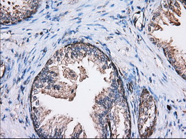 TS / Thromboxane Synthase Antibody - Immunohistochemical staining of paraffin-embedded Human prostate tissue using anti-TBXAS1 mouse monoclonal antibody. (Dilution 1:50).