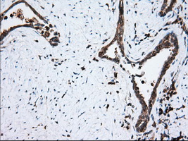 TS / Thromboxane Synthase Antibody - Immunohistochemical staining of paraffin-embedded Carcinoma of Human prostate tissue using anti-TBXAS1 mouse monoclonal antibody. (Dilution 1:50).