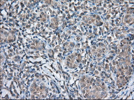 TS / Thromboxane Synthase Antibody - IHC of paraffin-embedded Carcinoma of Human thyroid tissue using anti-TBXAS1 mouse monoclonal antibody. (Dilution 1:50).