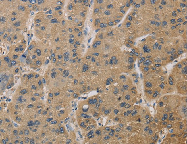 TS / Thromboxane Synthase Antibody - Immunohistochemistry of paraffin-embedded Human breast cancer using TBXAS1 Polyclonal Antibody at dilution of 1:30.