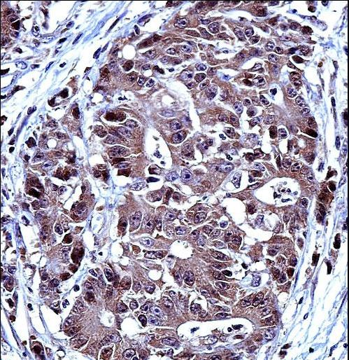TS / Thymidylate Synthase Antibody - TYSY Antibody immunohistochemistry of formalin-fixed and paraffin-embedded human colon carcinoma followed by peroxidase-conjugated secondary antibody and DAB staining.