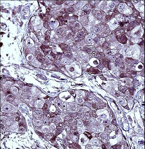 TS / Thymidylate Synthase Antibody - TYSY Antibody immunohistochemistry of formalin-fixed and paraffin-embedded human breast carcinoma followed by peroxidase-conjugated secondary antibody and DAB staining.