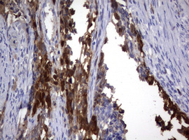 TS / Thymidylate Synthase Antibody - IHC of paraffin-embedded Adenocarcinoma of Human endometrium tissue using anti-TYMS mouse monoclonal antibody. (Heat-induced epitope retrieval by 10mM citric buffer, pH6.0, 120°C for 3min).